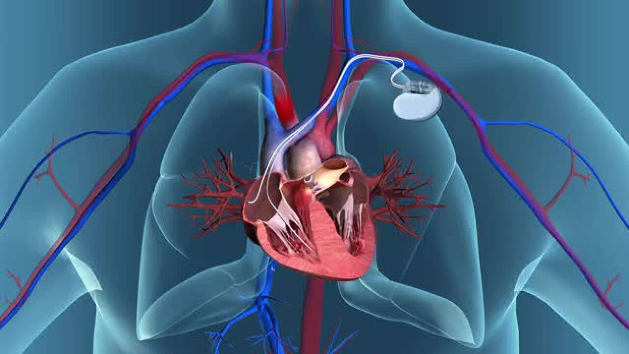 Sådan fungerer en pacemaker