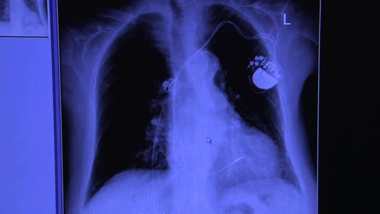 En pacemaker operation