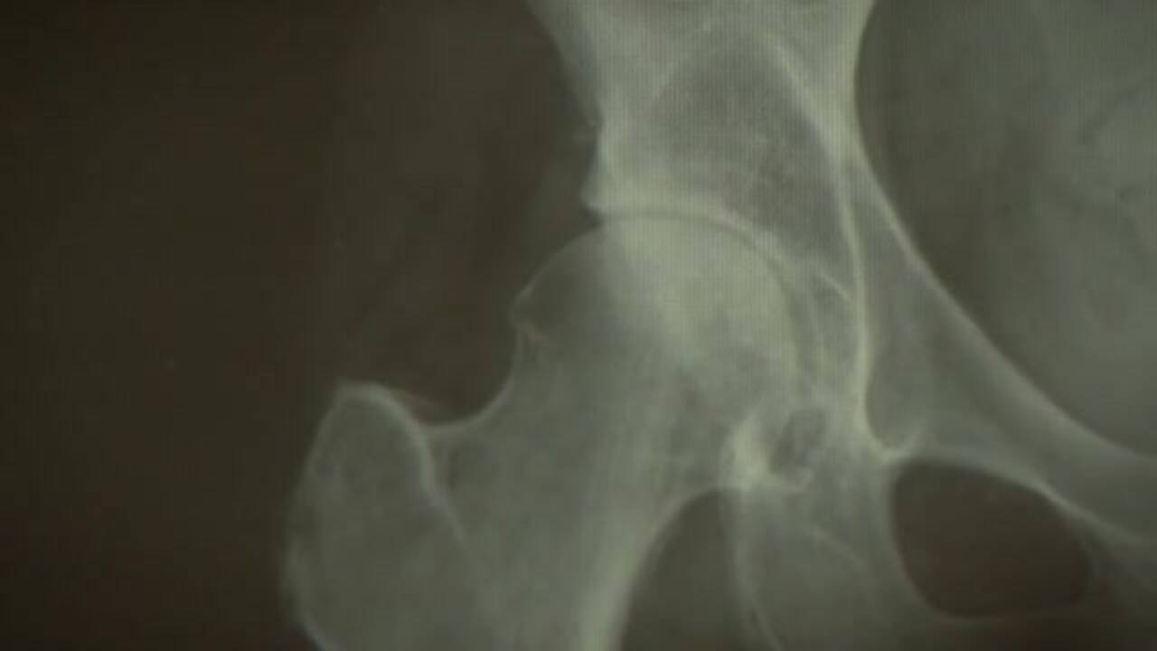 Røntgen for at vurdere graden af artrose i hoften